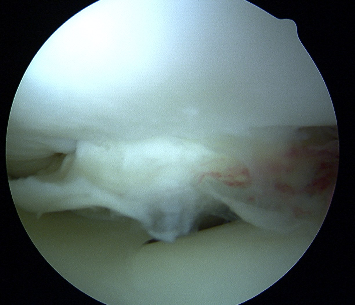 Lateral Femoral OCD Superior Displacement